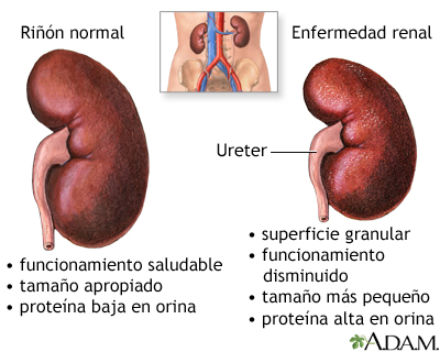 Nefropatía diabética