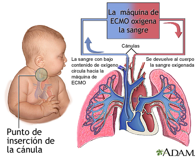 ECMO