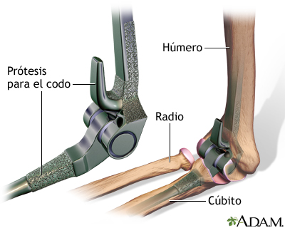 Prótesis para el codo