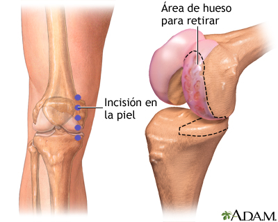 Incisión