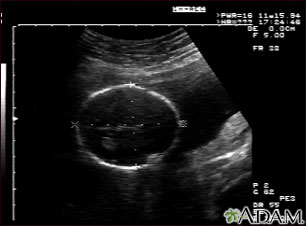 Ultrasonido de un feto normal; medidas de la cabeza