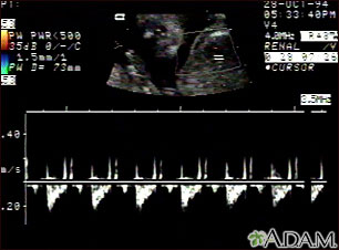 Ultrasonido normal de los latidos del feto