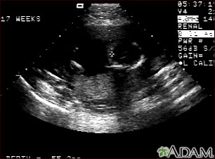 Ultrasonido de un feto normal; ventrículos cerebrales