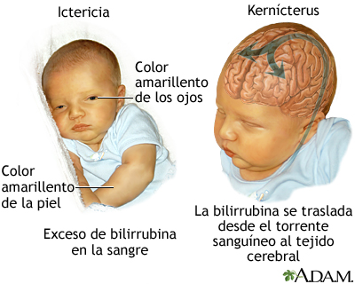 Kernícterus