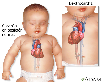 Dextrocardia