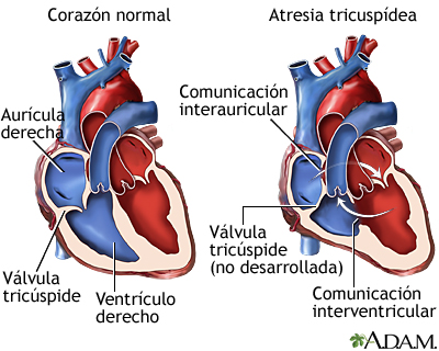 Atresia tricuspídea