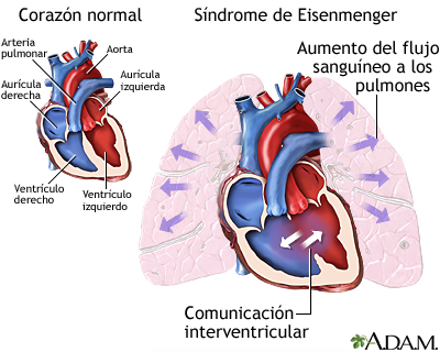 Síndrome de Eisenmenger