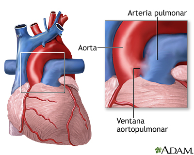 Ventana aortopulmonar