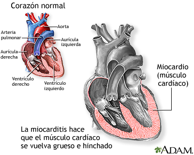 Miocarditis