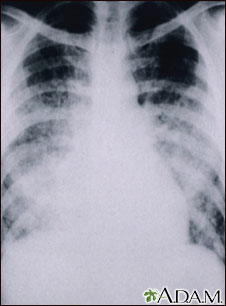 Pulmonía aguda por varicela - Rayos X de tórax