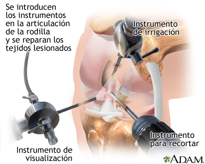 Artroscopia de rodilla