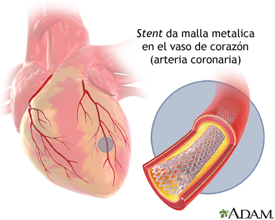 Stent de arteria coronaria