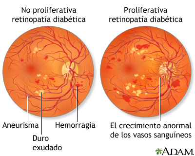 Retinopatía diabética