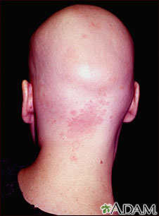 Alopecia total; vista posterior de la cabeza