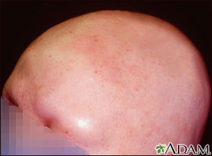 Alopecia total; vista frontal de la cabeza