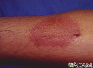 Dermatitis por contacto