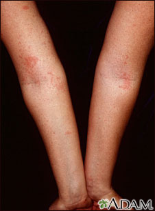 Dermatitis atópica de los brazos