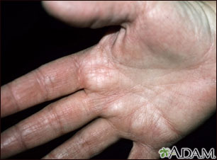 Hiperlinearidad de la dermatitis atópica de la palma de la mano