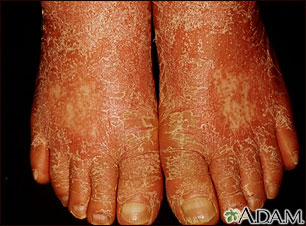 Pitiriasis rubra pilaris en los pies