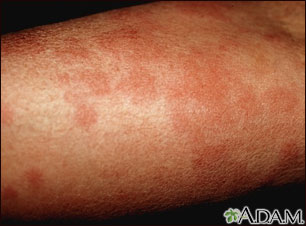 Ronchas (urticaria) en el brazo