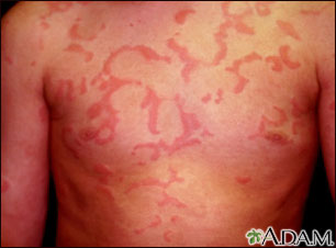 Ronchas (urticaria) en el pecho