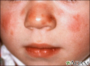 Lupus discoide en el rostro de un niño