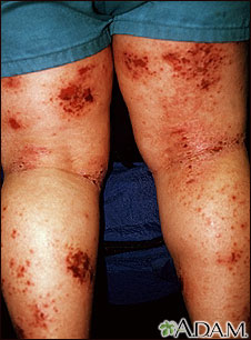 Dermatitis atópica de las piernas