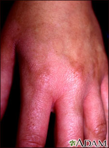 Fitofotodermatitis de la mano