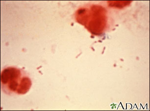 Haemophilus influenzae