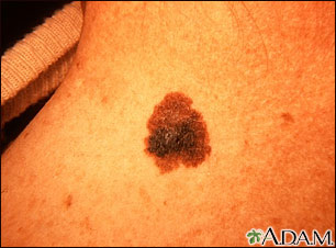 Melanoma del cuello