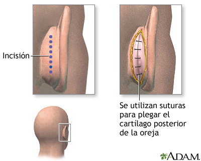 Procedimiento