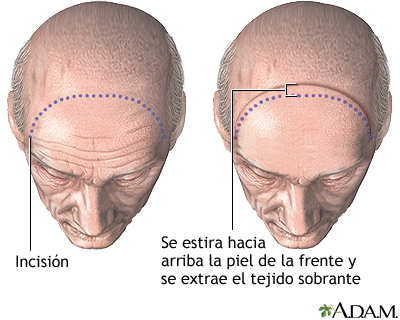 Procedimiento