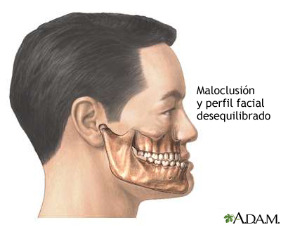 Maloclusión de los dientes