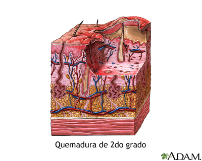 Quemadura de segundo grado