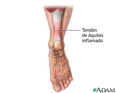 Tendón de Aquiles inflamado