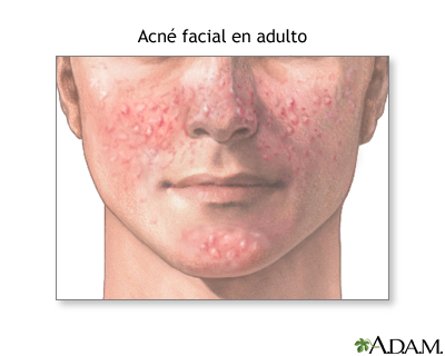 Acné facial del adulto