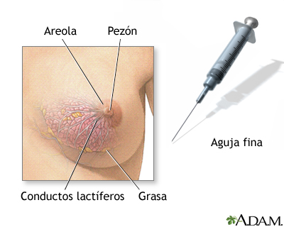 Biopsia de mama femenina