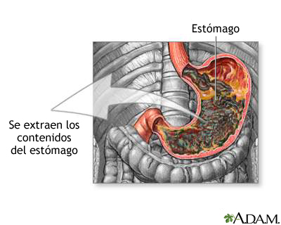 Succión gástrica