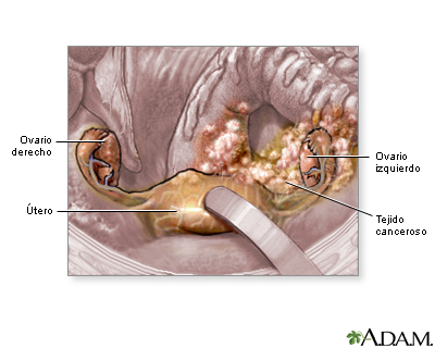 Cáncer ovárico