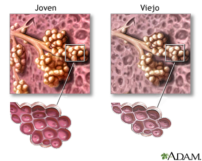 Cambios en el tejido pulmonar por el envejecimiento