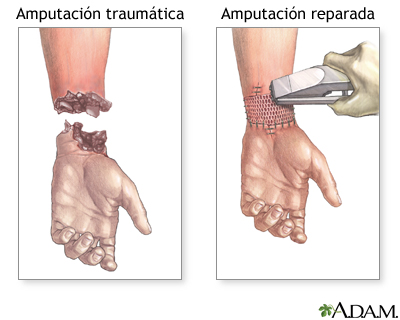 Reparaci&#243;n de amputaci&#243;n