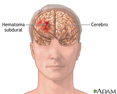 Hematoma subdural