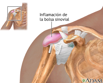 Bursitis del hombro