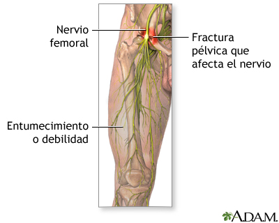 Da&#241;o al nervio femoral