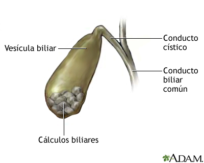 C&#225;lculos biliares