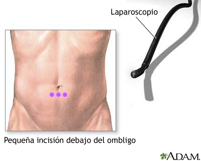 Incisión para realizar laparoscopia abdominal