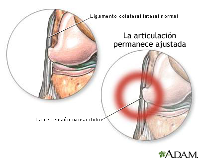 Dolor del ligamento colateral externo