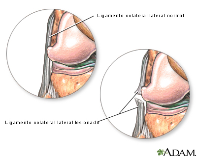 Ligamento colateral lateral desgarrado