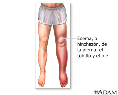 Edema en la parte baja de la pierna