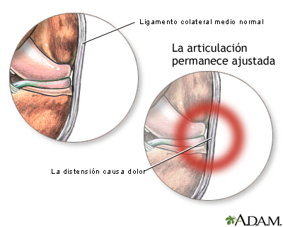 Dolor del ligamento medial colateral